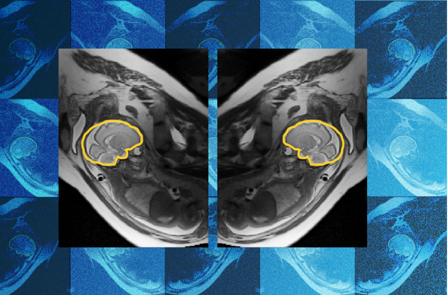 Why teaching AI about symmetry could make prenatal diagnosis more reliable